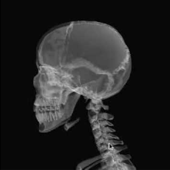X-ray Mandible Oblique View